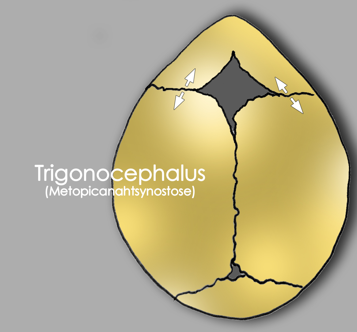 Frontalnahtsynostose Kraniohelden e.V.